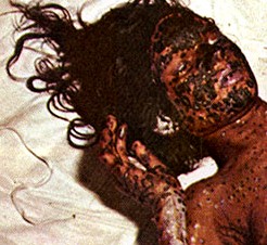 Hemorrhagic Small Pox
